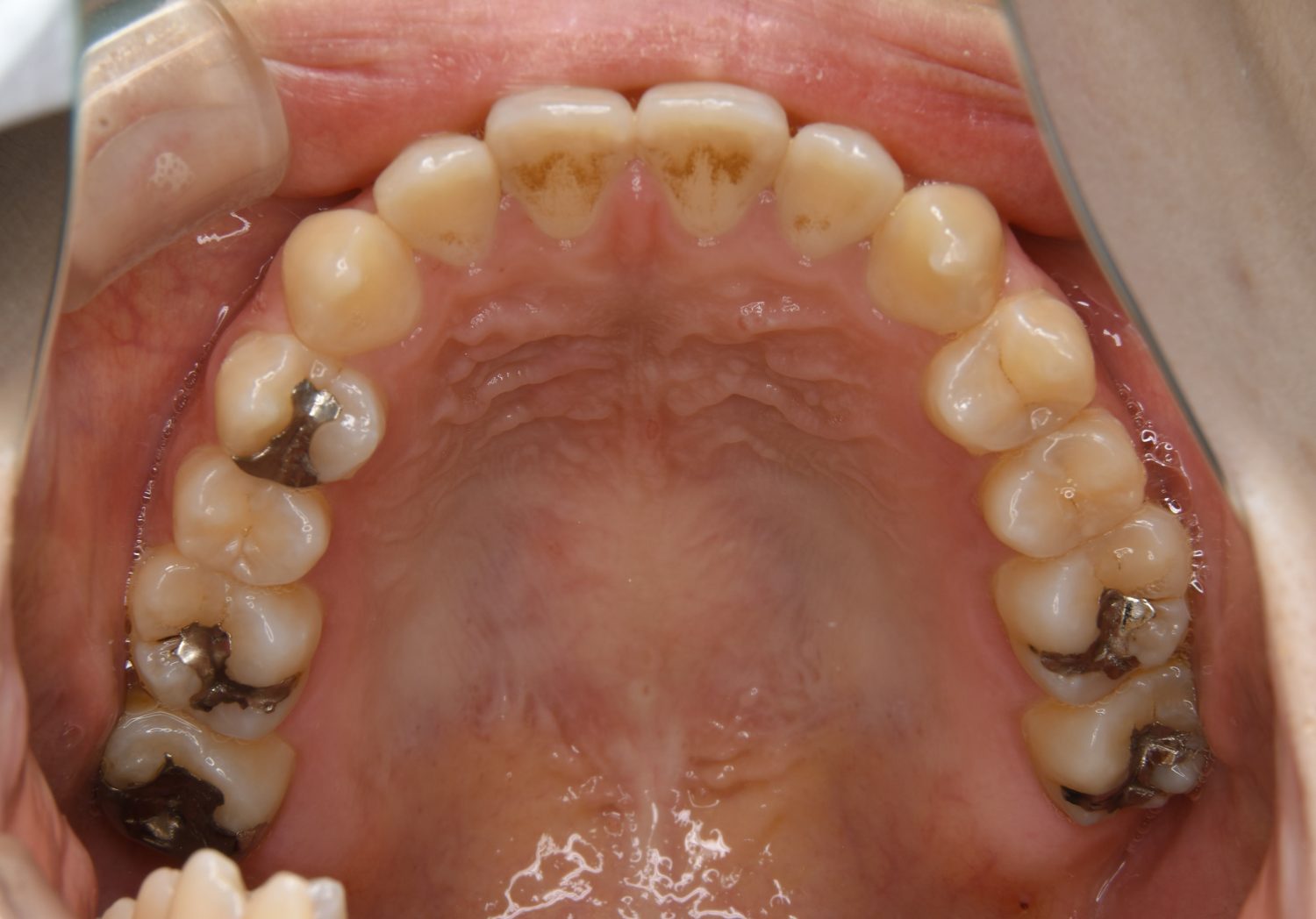 ピーススマイル矯正歯科 前歯部開咬① before 上側