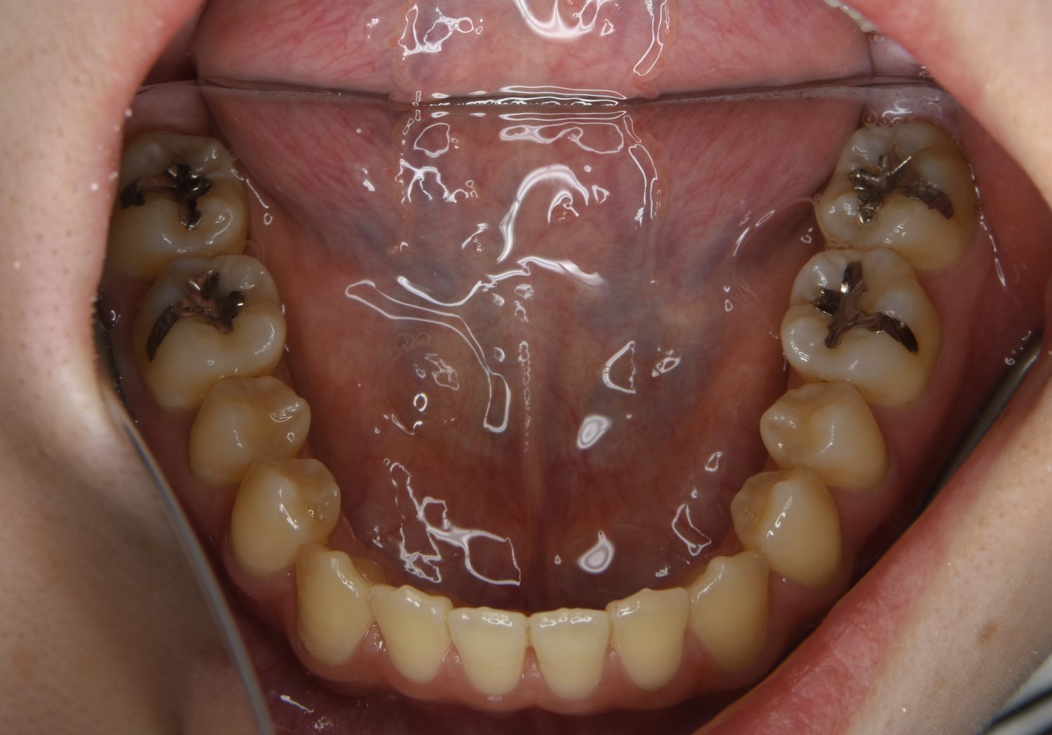 ピーススマイル矯正歯科 前歯部開咬① after 下側