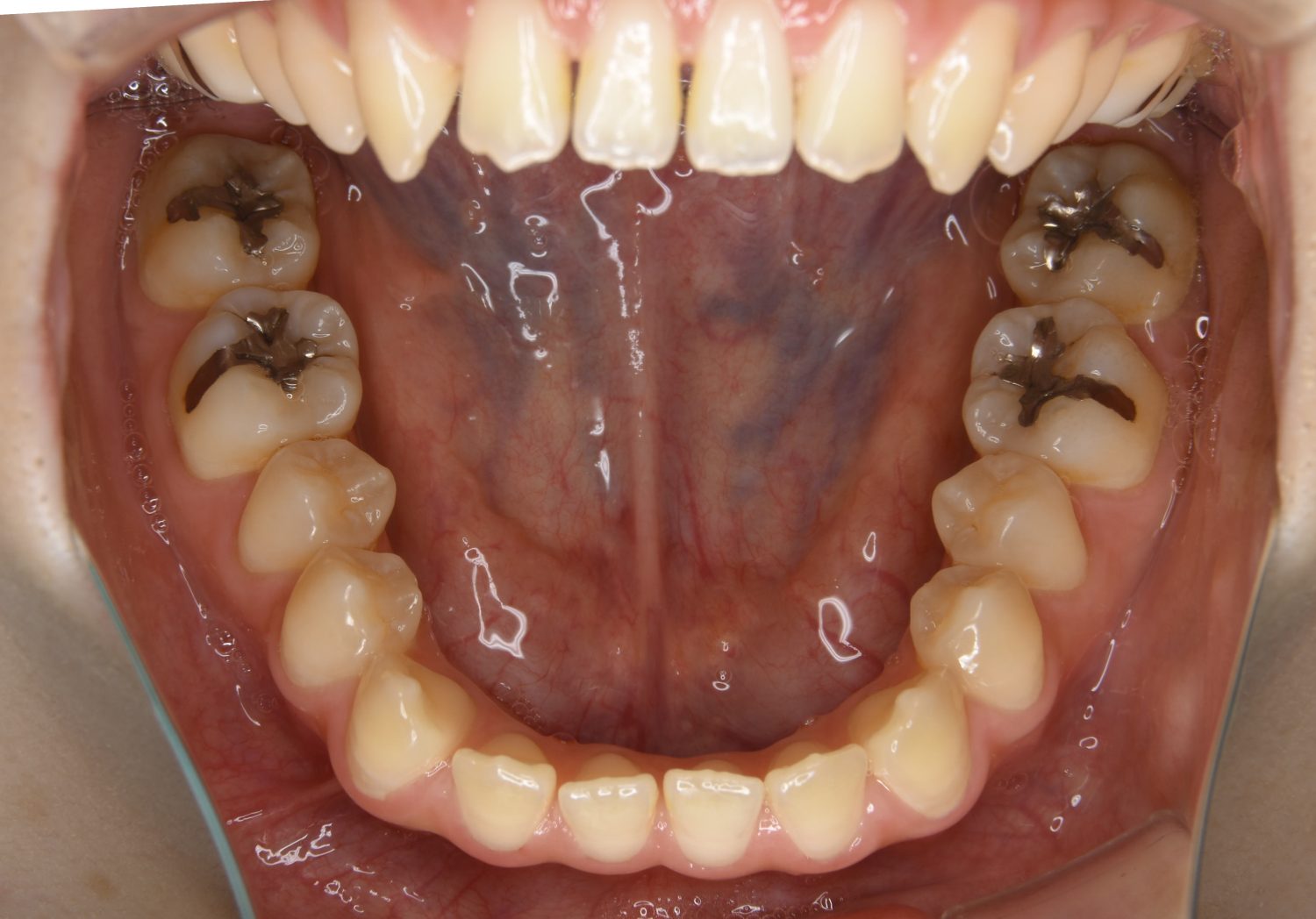 ピーススマイル矯正歯科 前歯部開咬① before 下側