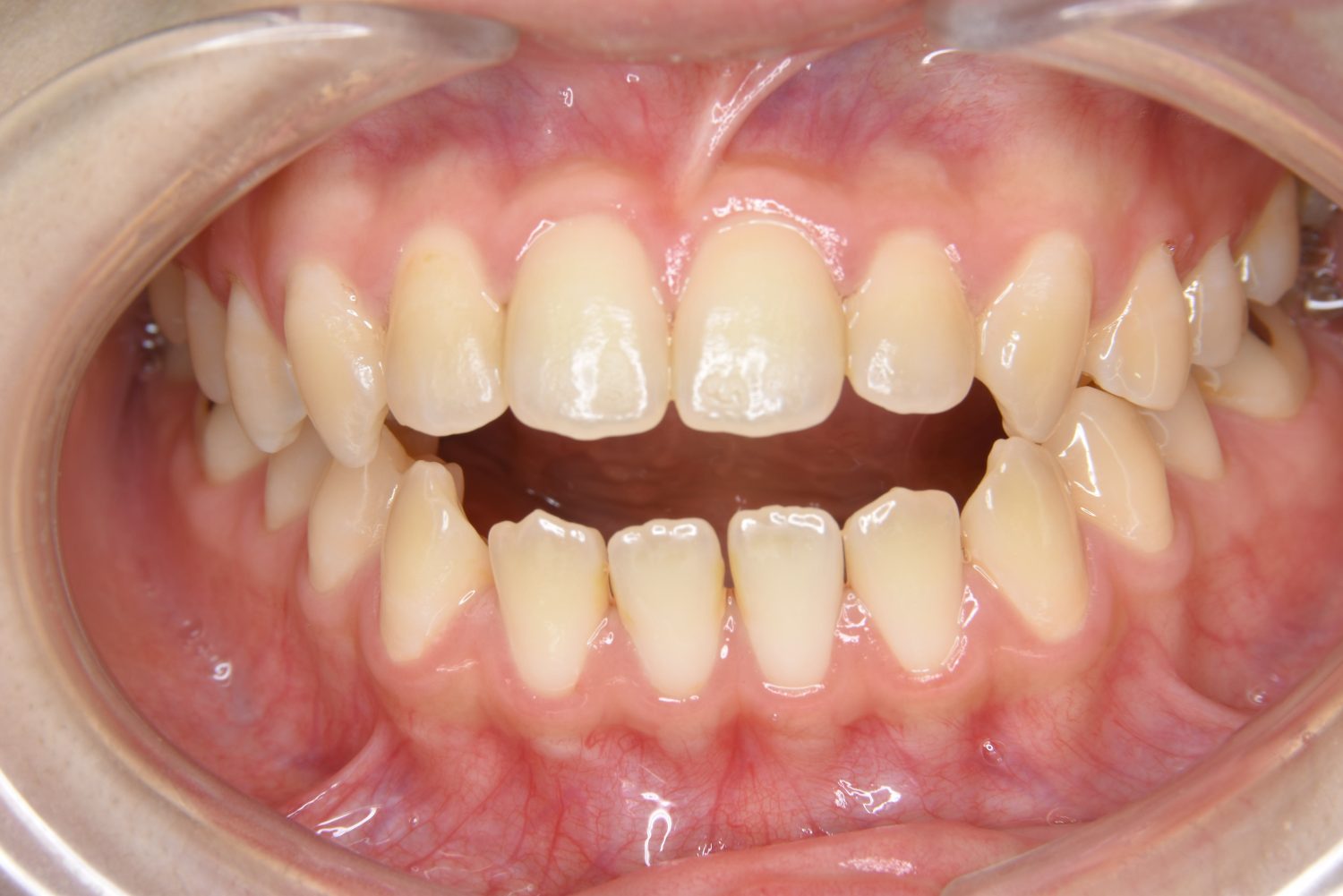 ピーススマイル矯正歯科 前歯部開咬 before