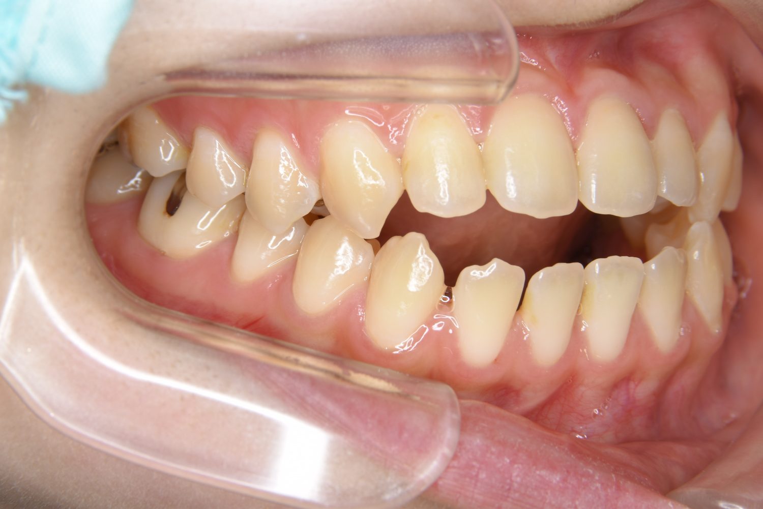 ピーススマイル矯正歯科 前歯部開咬① before 右側