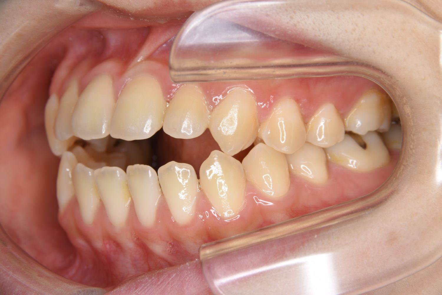 ピーススマイル矯正歯科 前歯部開咬① before 左側