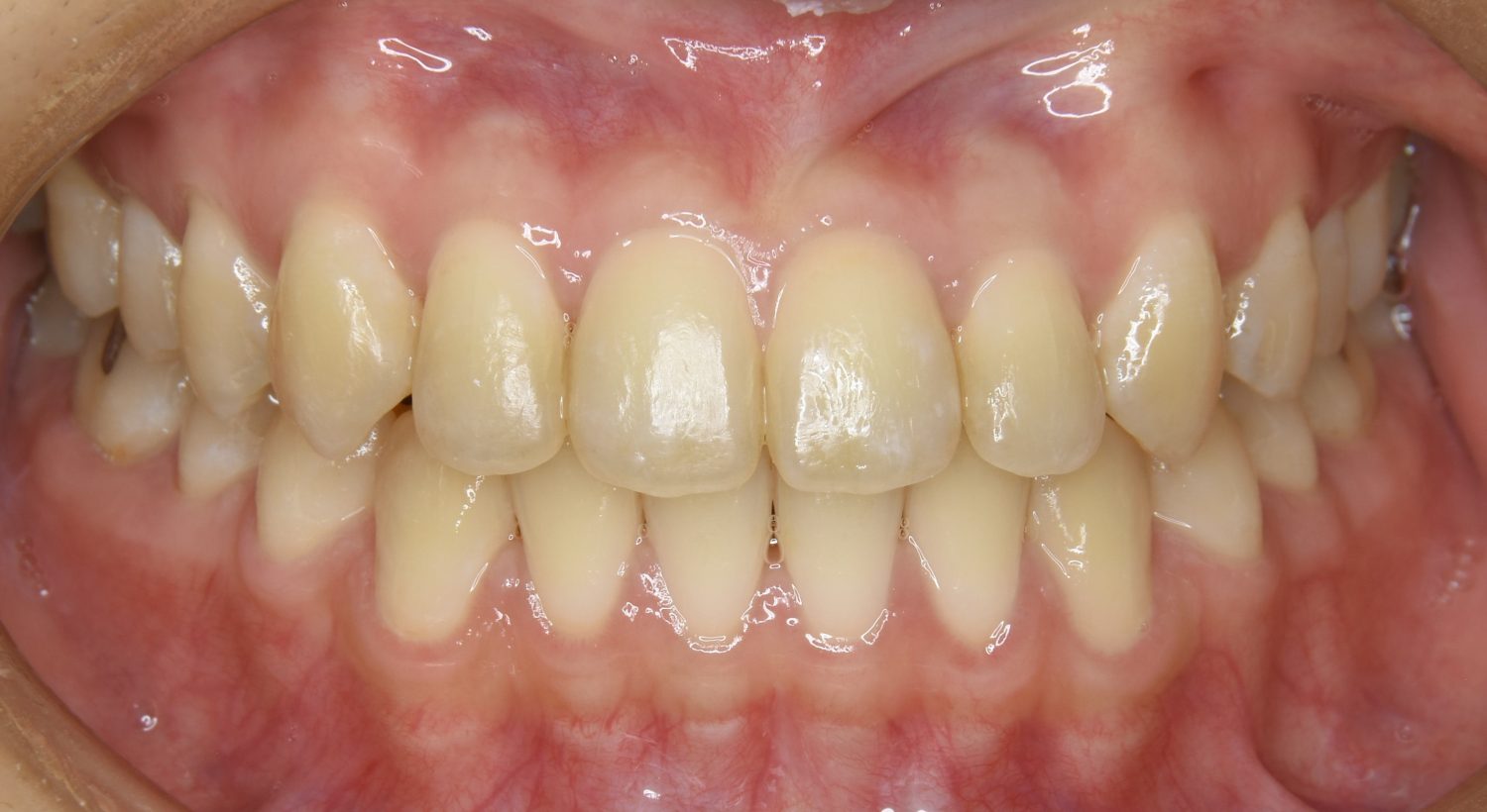 ピーススマイル矯正歯科 前歯部開咬① after 正面