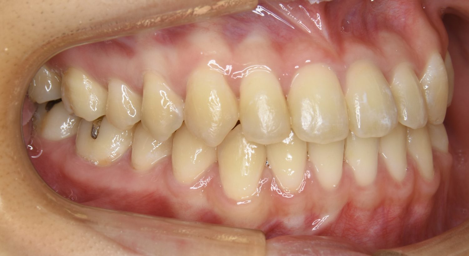 ピーススマイル矯正歯科 前歯部開咬① after 右側