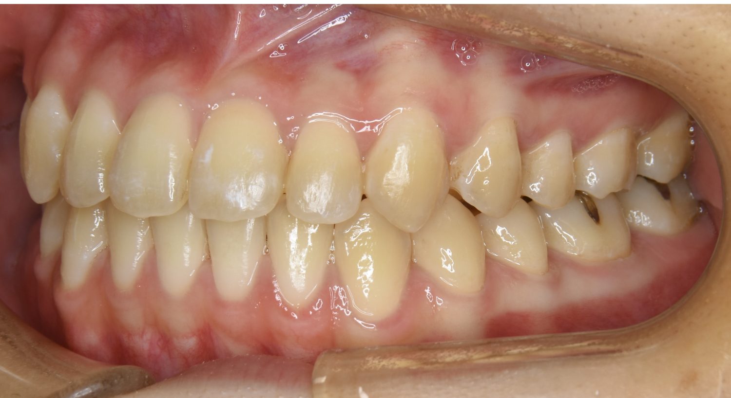 ピーススマイル矯正歯科 前歯部開咬① after 左側