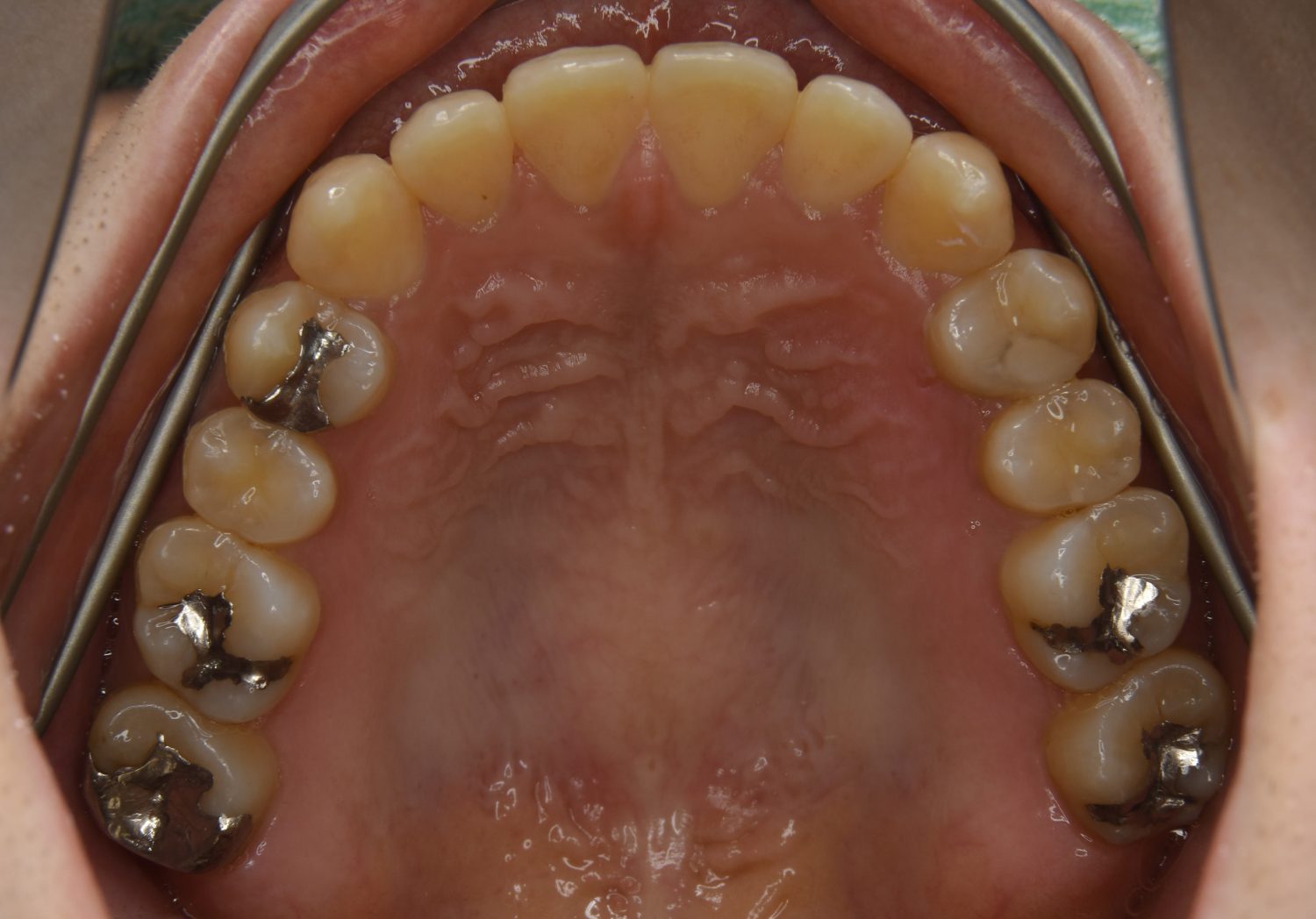 ピーススマイル矯正歯科 前歯部開咬① after 上側