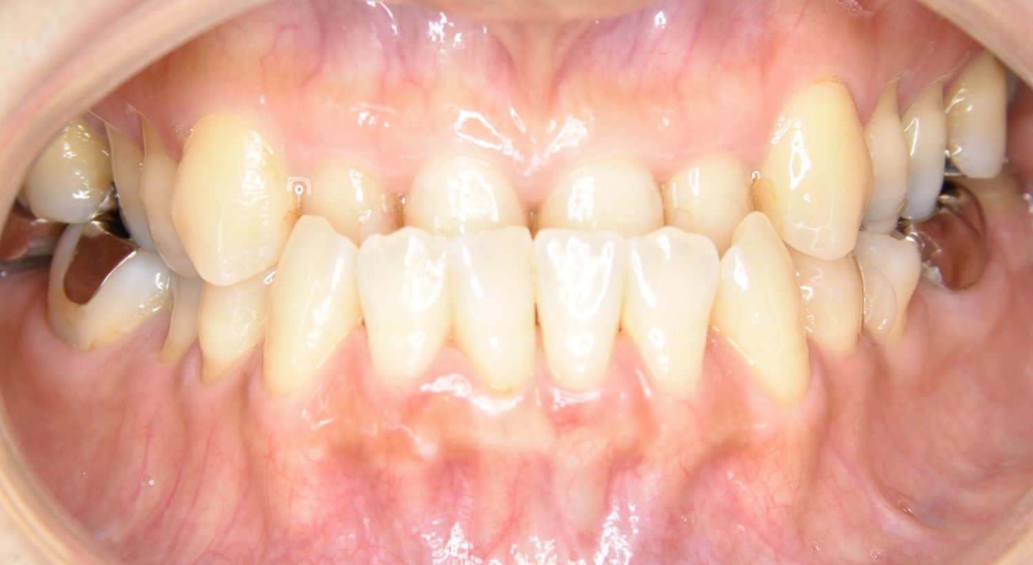 ピーススマイル矯正歯科 下顎前突 before