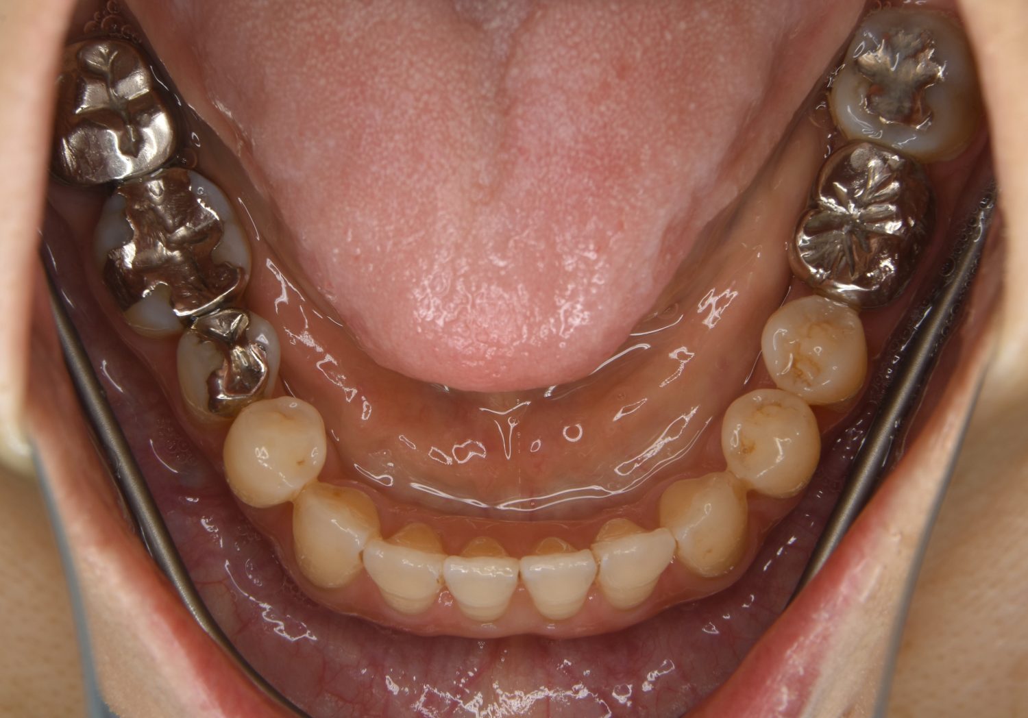 ピーススマイル矯正歯科 下顎前突 after 下側