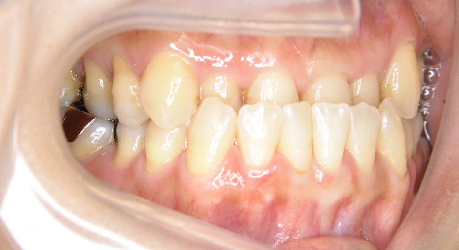 ピーススマイル矯正歯科 下顎前突 before 右側