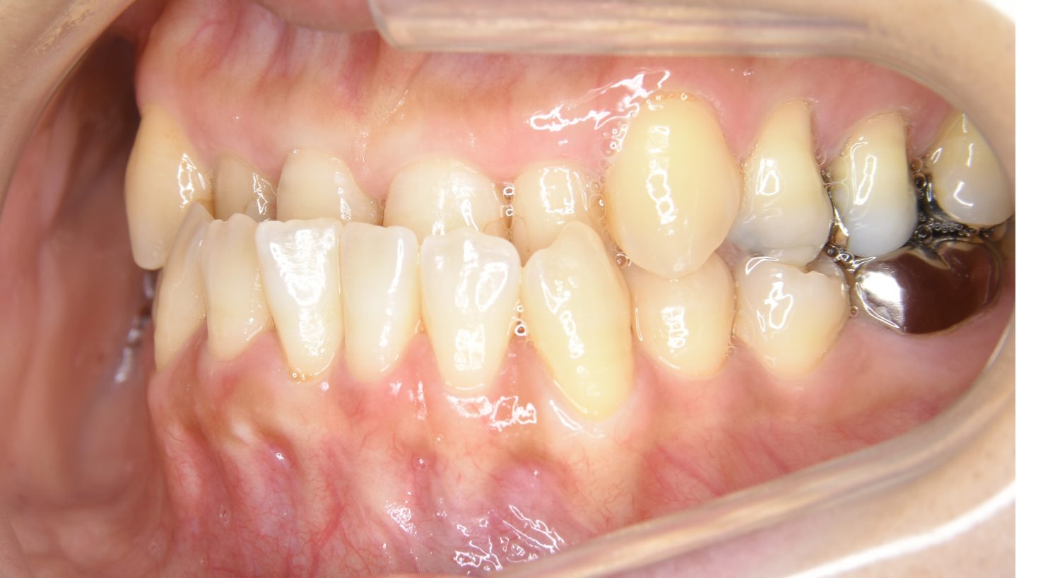 ピーススマイル矯正歯科 下顎前突 before 左側