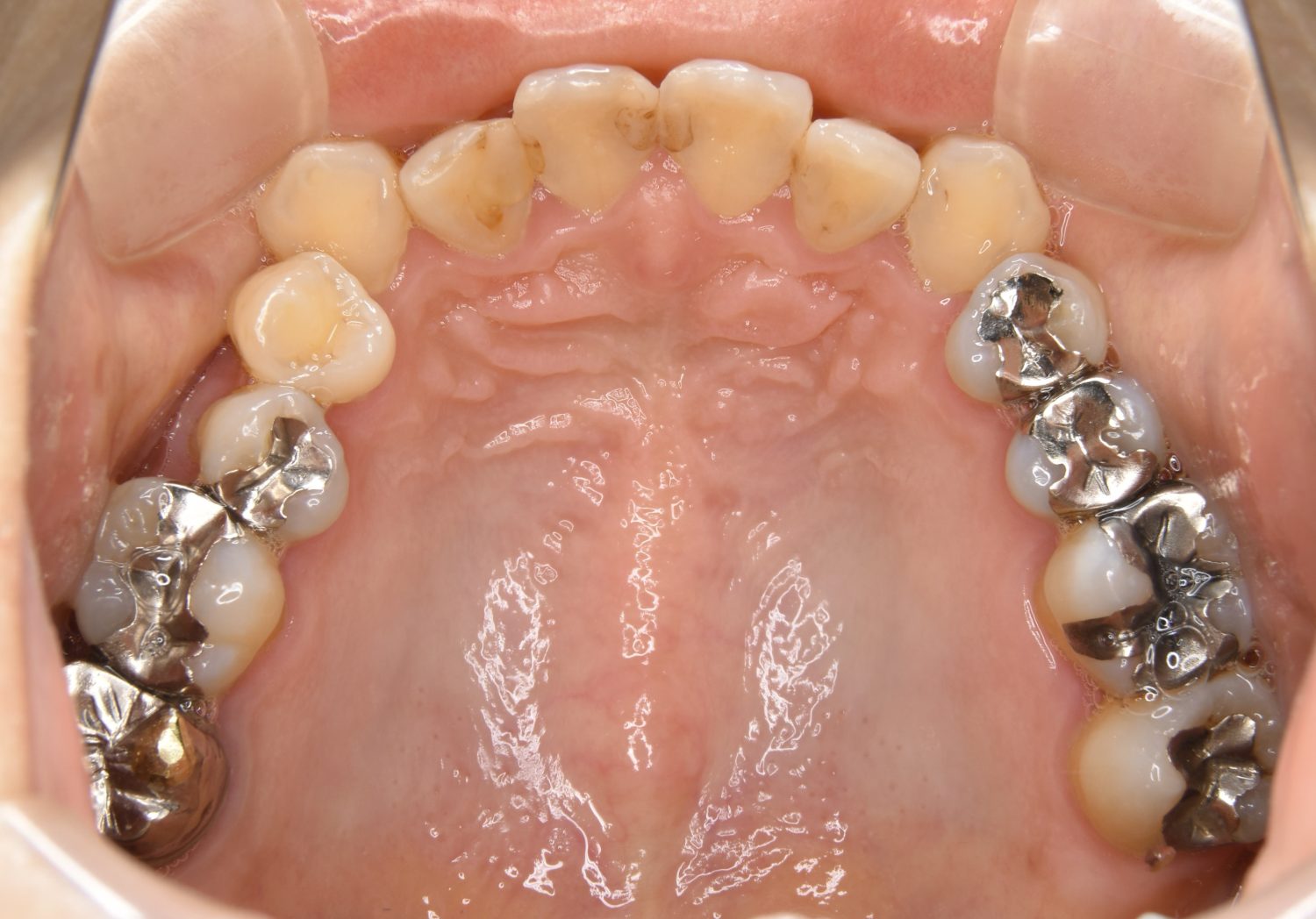 ピーススマイル矯正歯科 下顎前突 before 上側