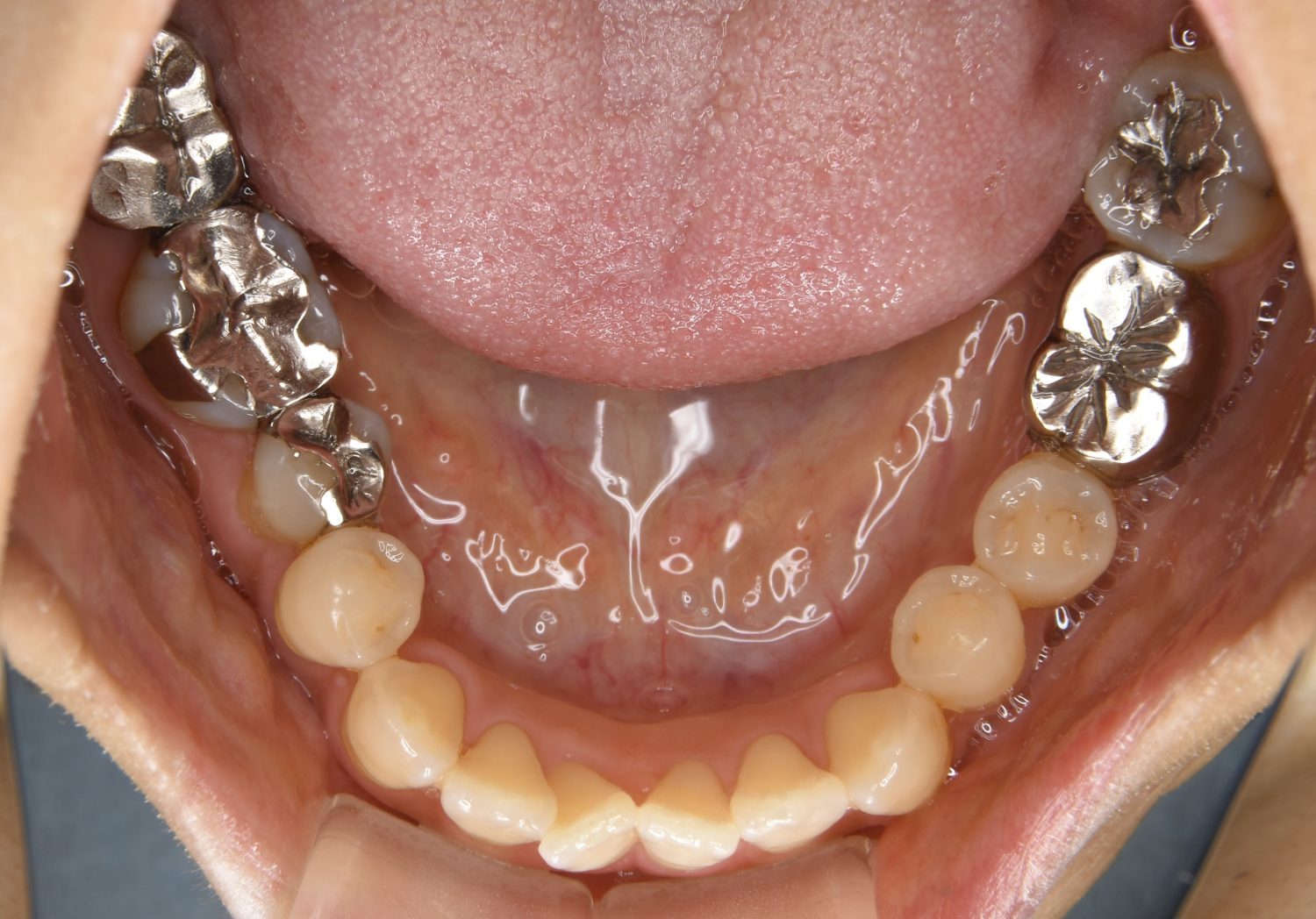 ピーススマイル矯正歯科 下顎前突 before 下側