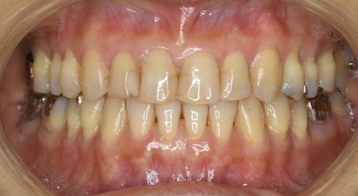 ピーススマイル矯正歯科 下顎前突 after 正面