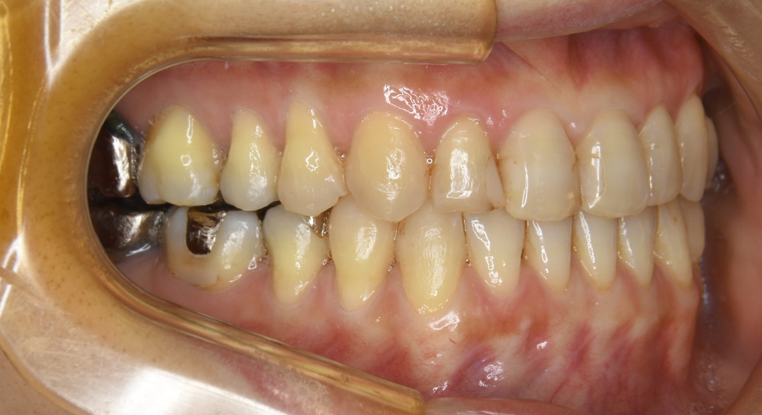 ピーススマイル矯正歯科 下顎前突 after 右側
