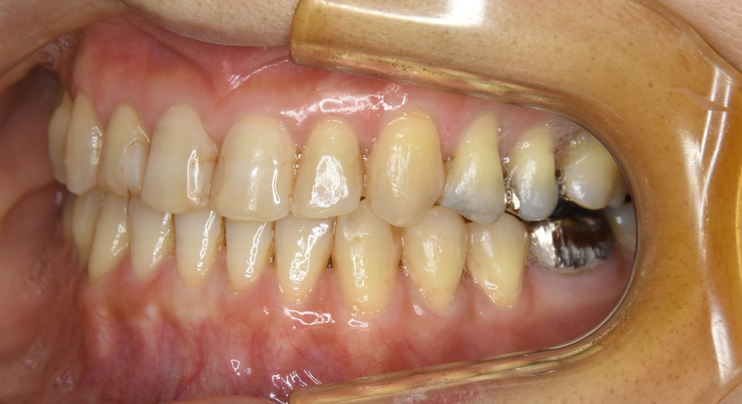 ピーススマイル矯正歯科 下顎前突 after 左側