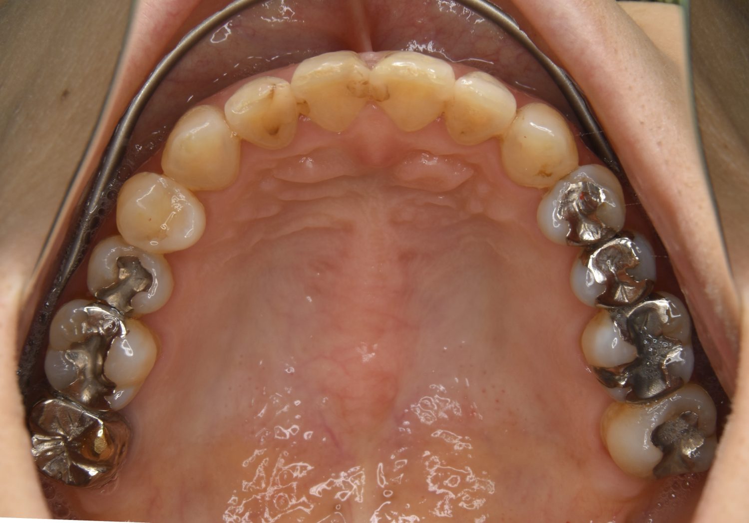 ピーススマイル矯正歯科 下顎前突 after 上側