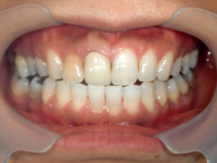 はりま歯科クリニック-ホワイトニング⑥-before-正面