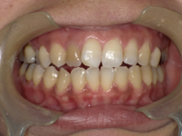 はりま歯科クリニック-ホワイトニング⑤-before-正面