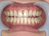 はりま歯科クリニック-ホワイトニング②-after-正面