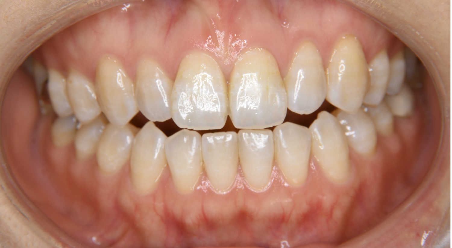 ピーススマイル矯正歯科 前歯部開咬 before