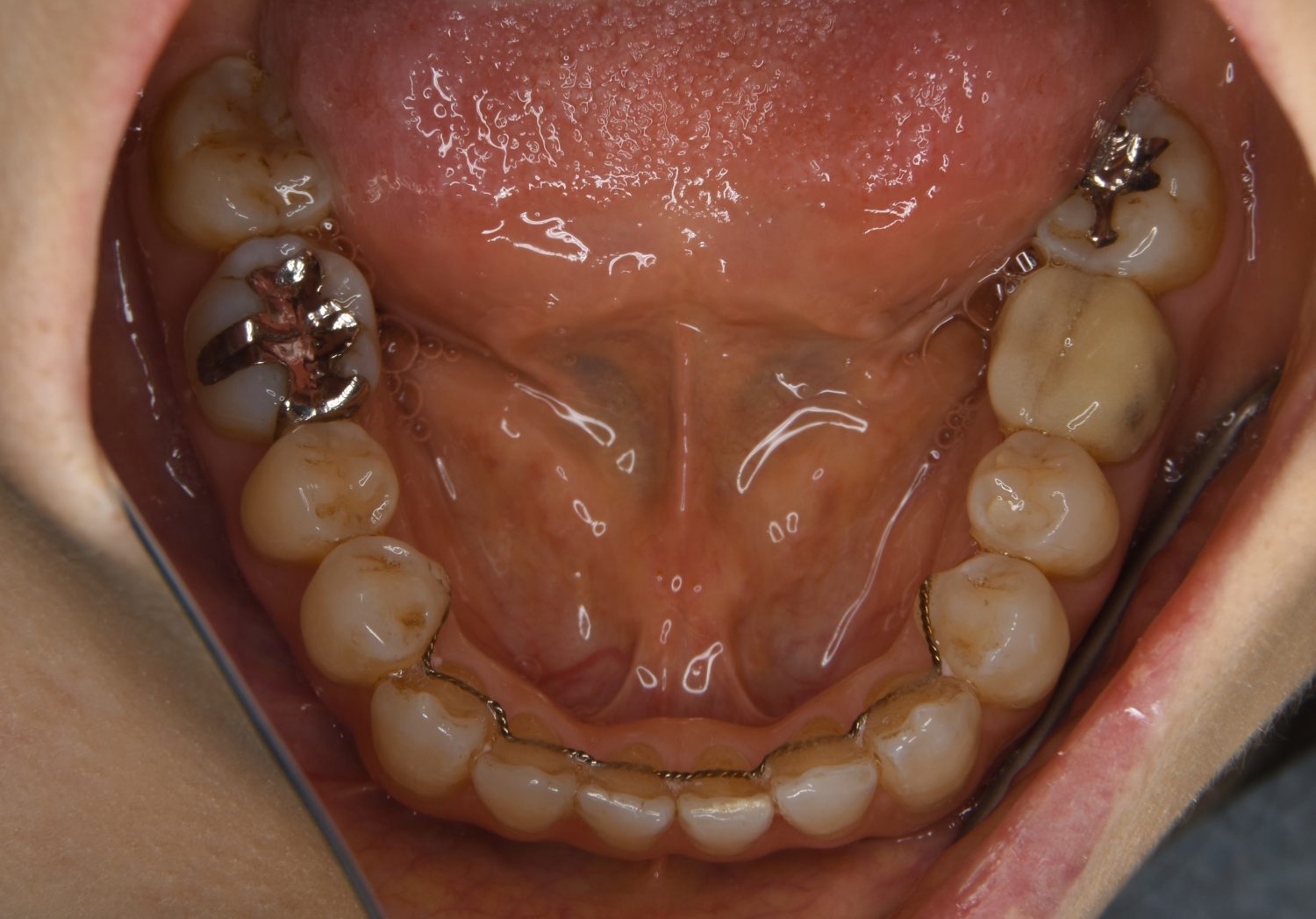 ピーススマイル矯正歯科 前歯部開咬② after 下側