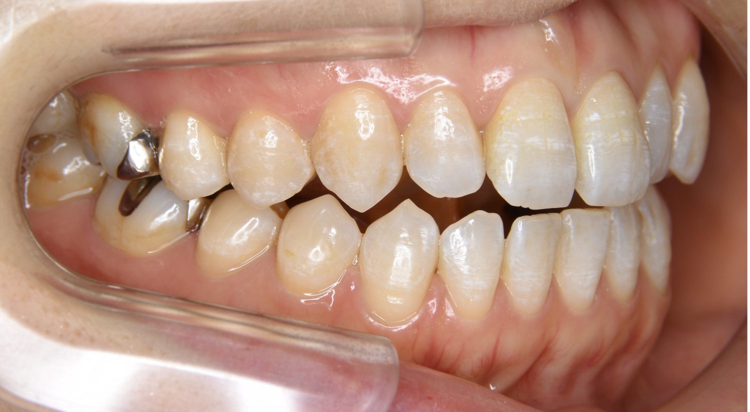 ピーススマイル矯正歯科 前歯部開咬② before 右側