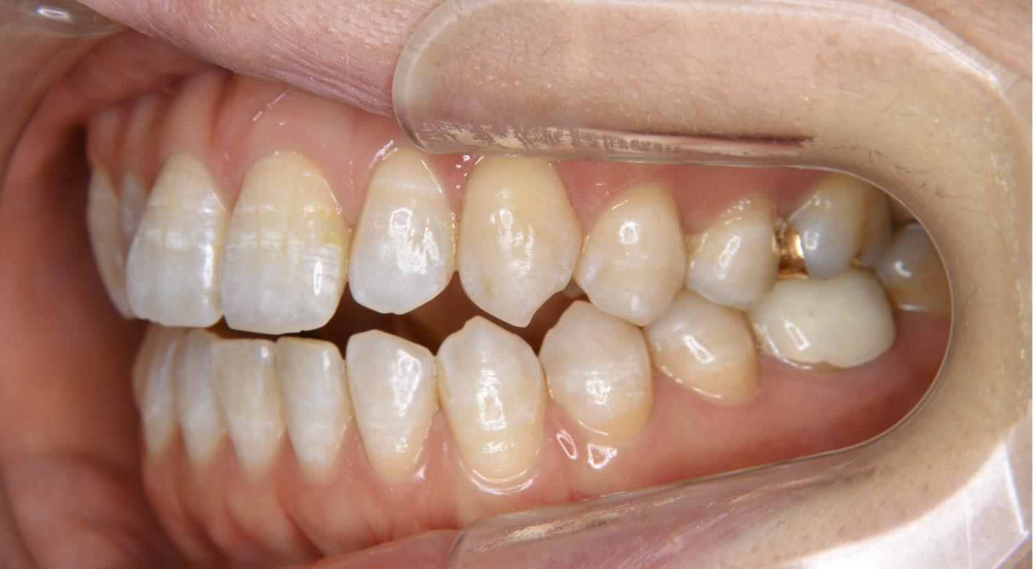 ピーススマイル矯正歯科 前歯部開咬② before 左側