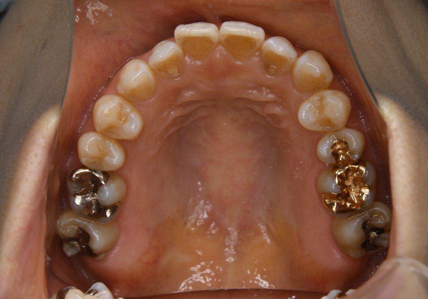 ピーススマイル矯正歯科 前歯部開咬② before 上側