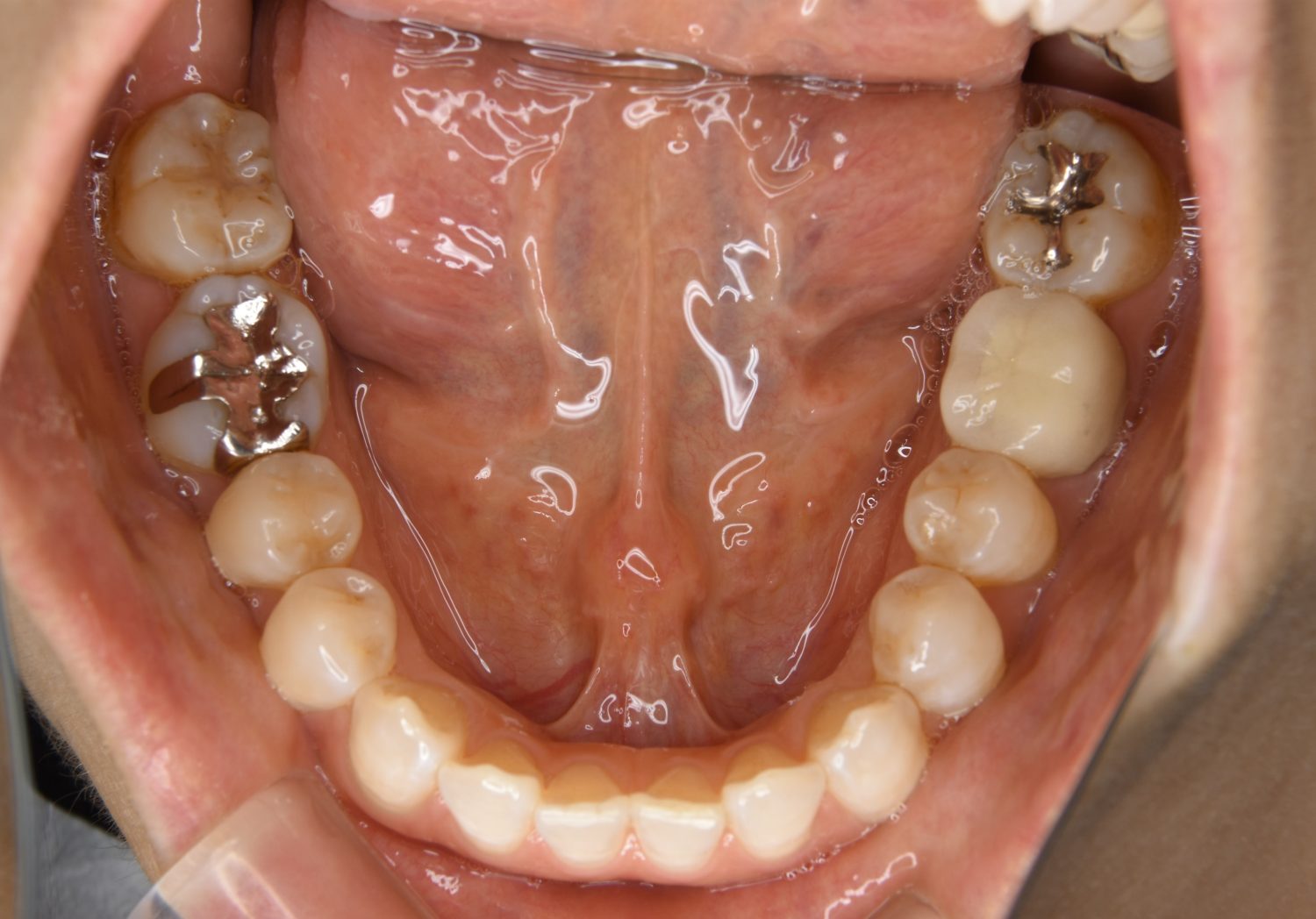 ピーススマイル矯正歯科 前歯部開咬② before 下側