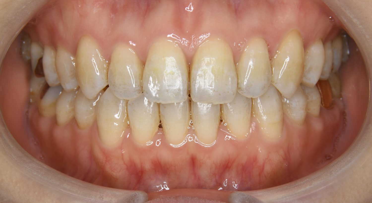 ピーススマイル矯正歯科 前歯部開咬② after 正面