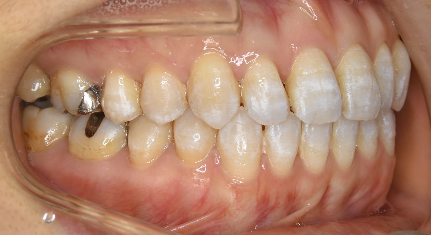 ピーススマイル矯正歯科 前歯部開咬② after 右側