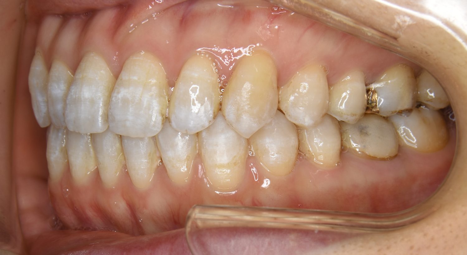 ピーススマイル矯正歯科 前歯部開咬② after 左側