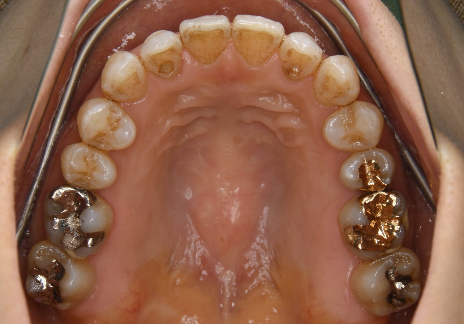 ピーススマイル矯正歯科 前歯部開咬② after 上側