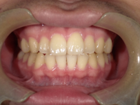 はりま歯科クリニック-ホワイトニング①-before-正面