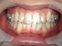 はりま歯科クリニック-ホワイトニング⑧-before-正面