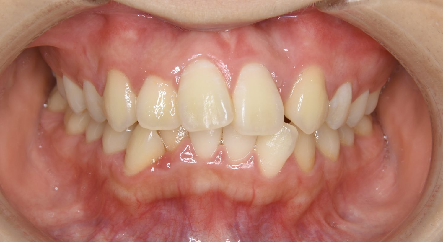 ピーススマイル矯正歯科 叢生① before