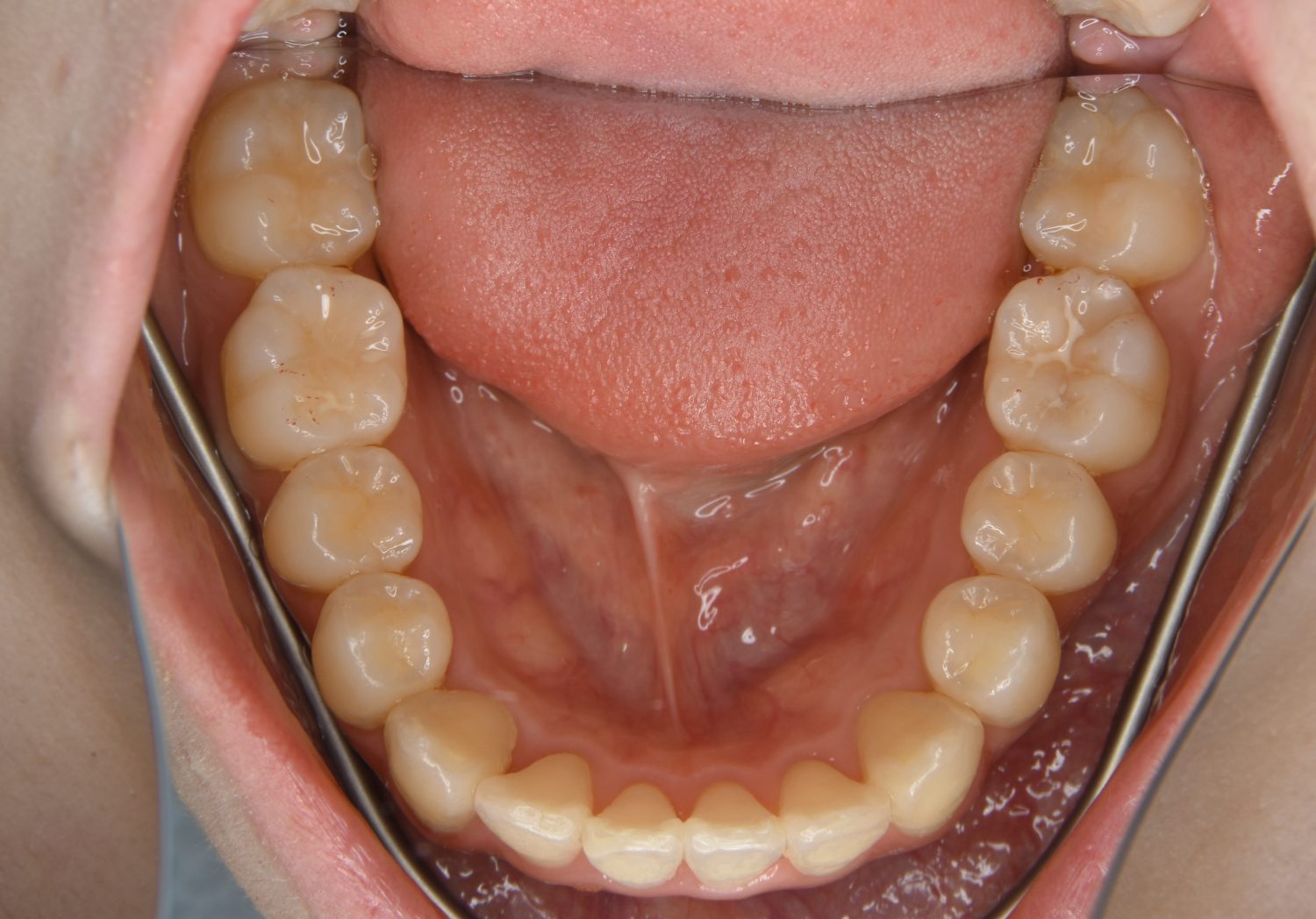 ピーススマイル矯正歯科 叢生① after 下側