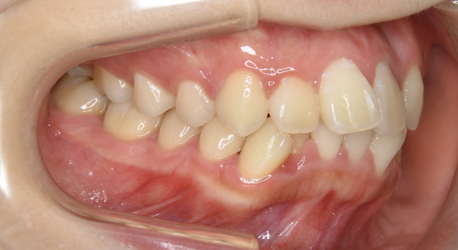 ピーススマイル矯正歯科 叢生① before 右側