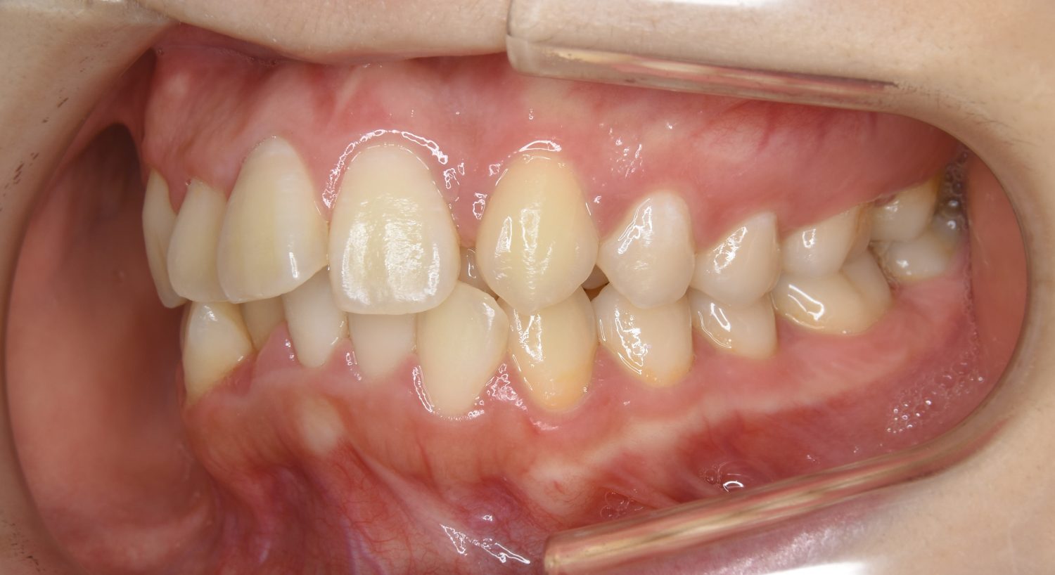 ピーススマイル矯正歯科 叢生① before 左側