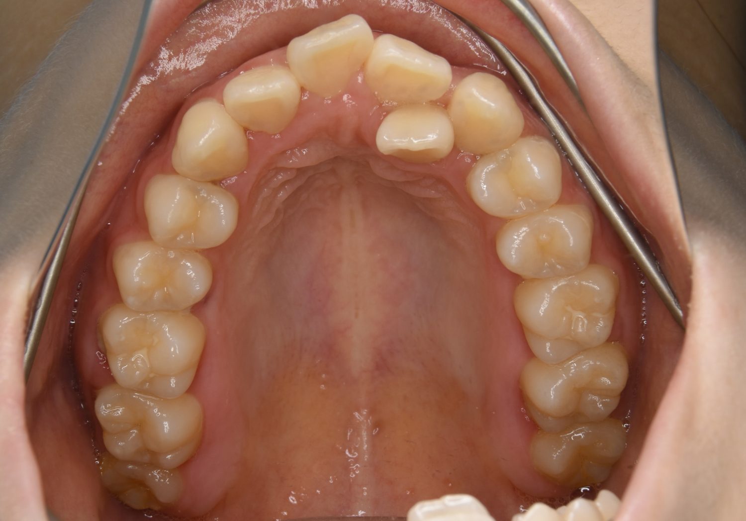 ピーススマイル矯正歯科 叢生① before 上側