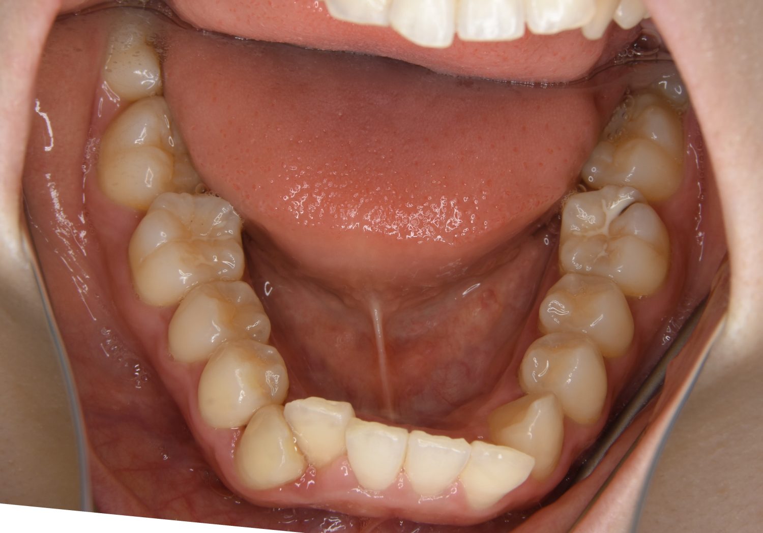 ピーススマイル矯正歯科 叢生① before 下側