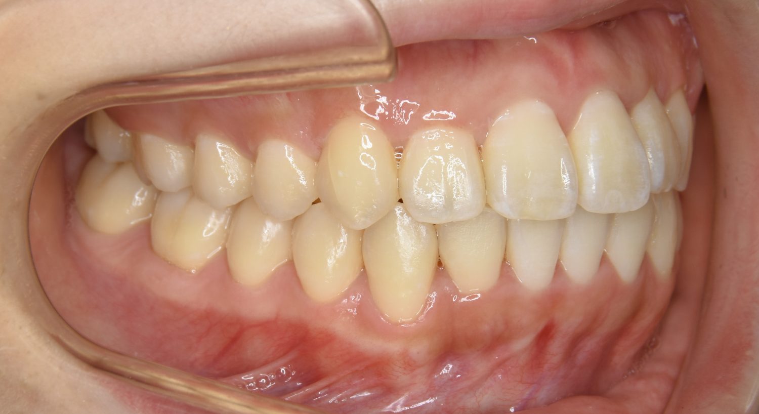 ピーススマイル矯正歯科 叢生① after 右側