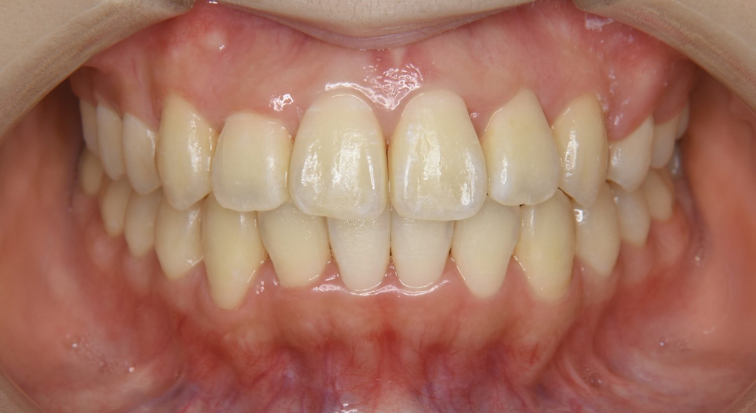 ピーススマイル矯正歯科 叢生① after 正面