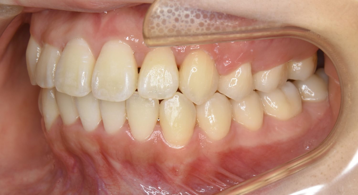 ピーススマイル矯正歯科 叢生① after 左側