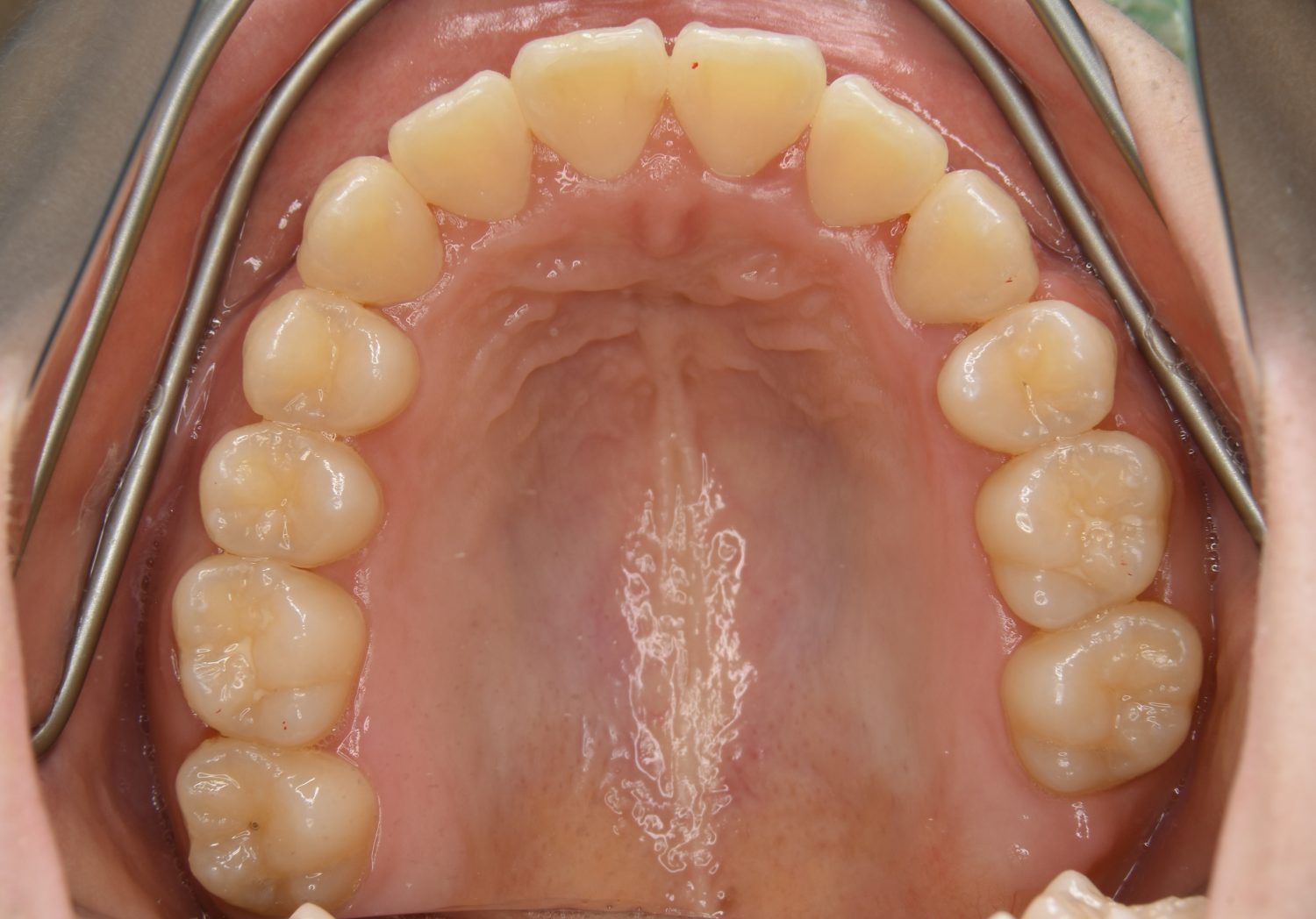 ピーススマイル矯正歯科 叢生① after 上側