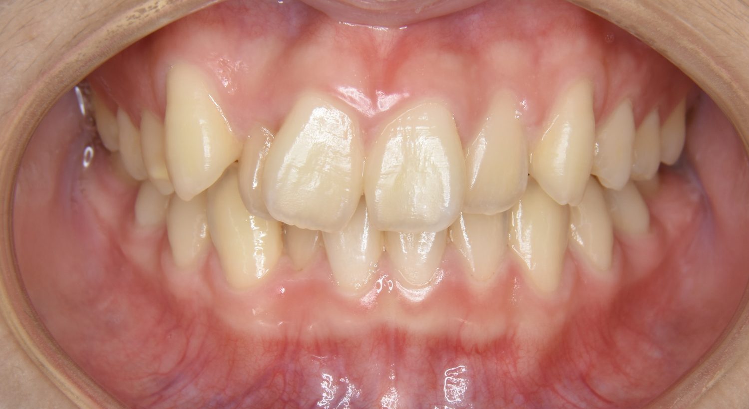 ピーススマイル矯正歯科 叢生② before