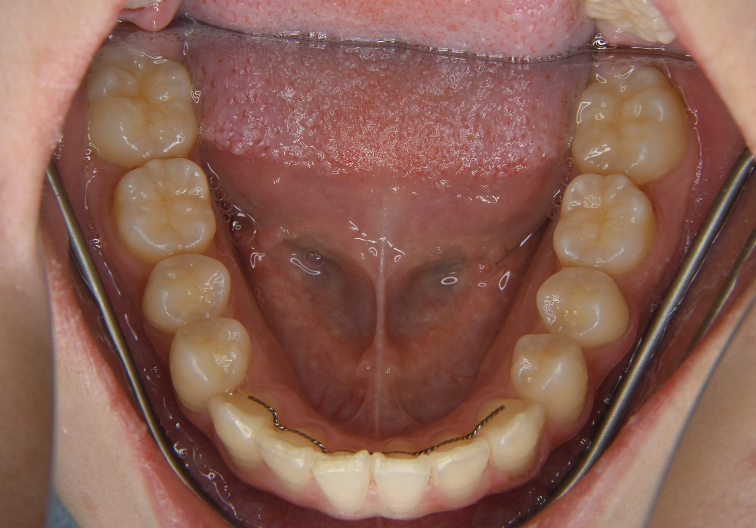 ピーススマイル矯正歯科 叢生② after 下側