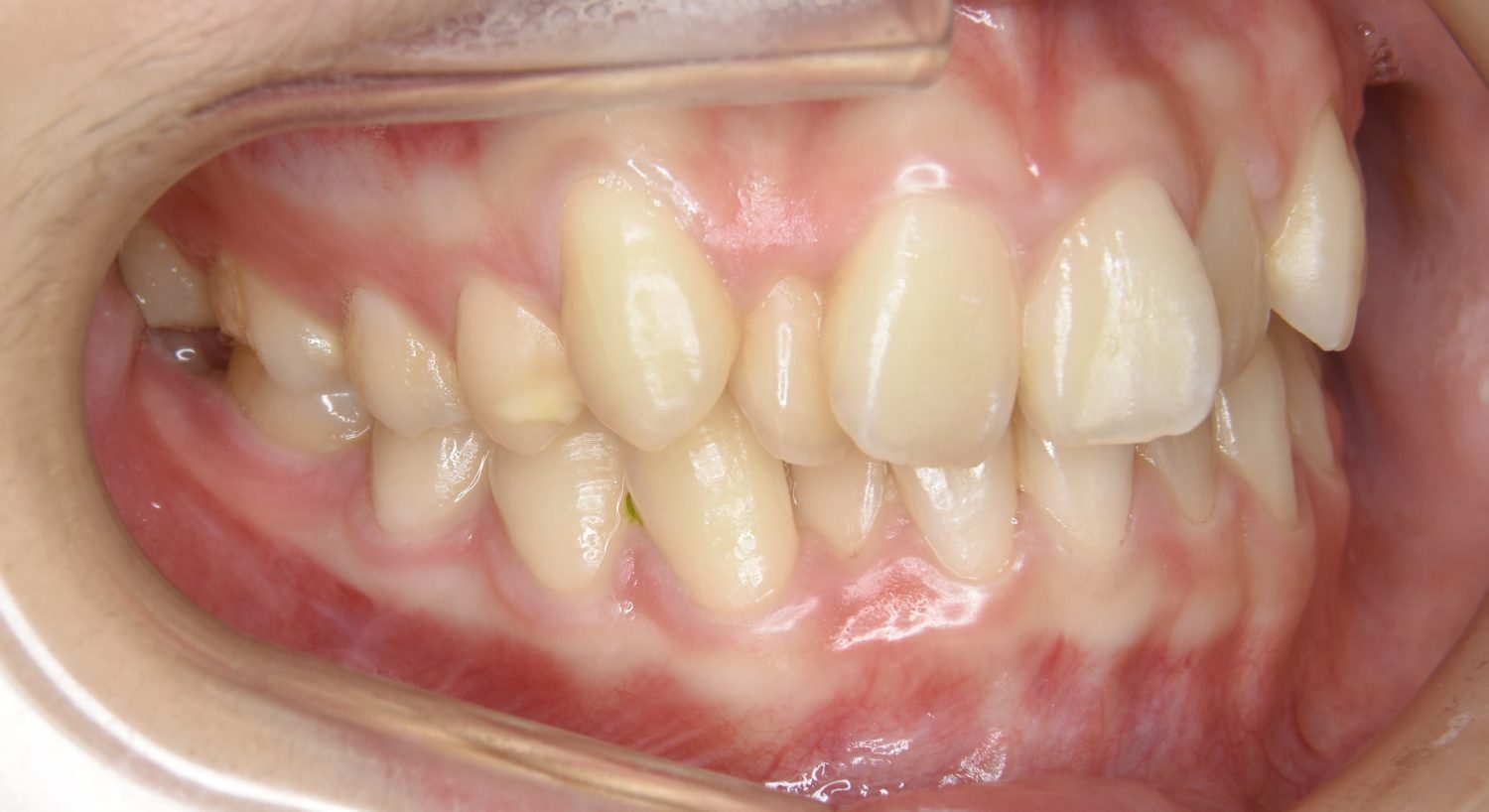 ピーススマイル矯正歯科 叢生② before 右側