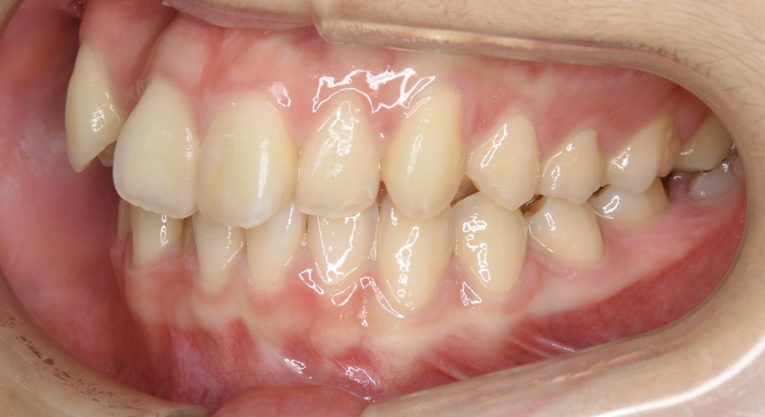 ピーススマイル矯正歯科 叢生② before 左側