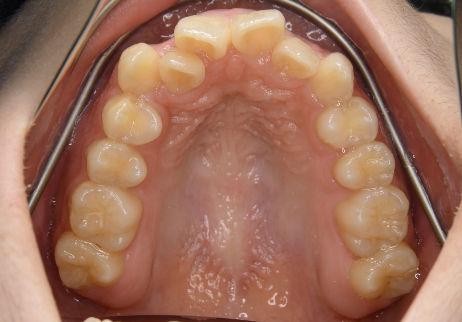 ピーススマイル矯正歯科 叢生② before 上側